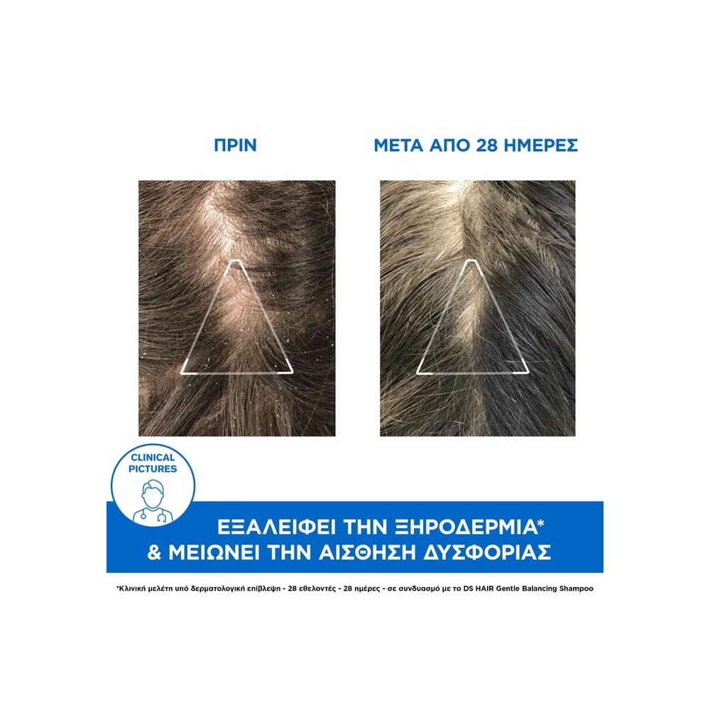 Preview 2 of Uriage Ds Hair Anti Dandruff Treatment Shampoo 200ml (Σαμπουάν για Μέτρια Πιτυρίδα Ξηρή ή Λιπαρή)